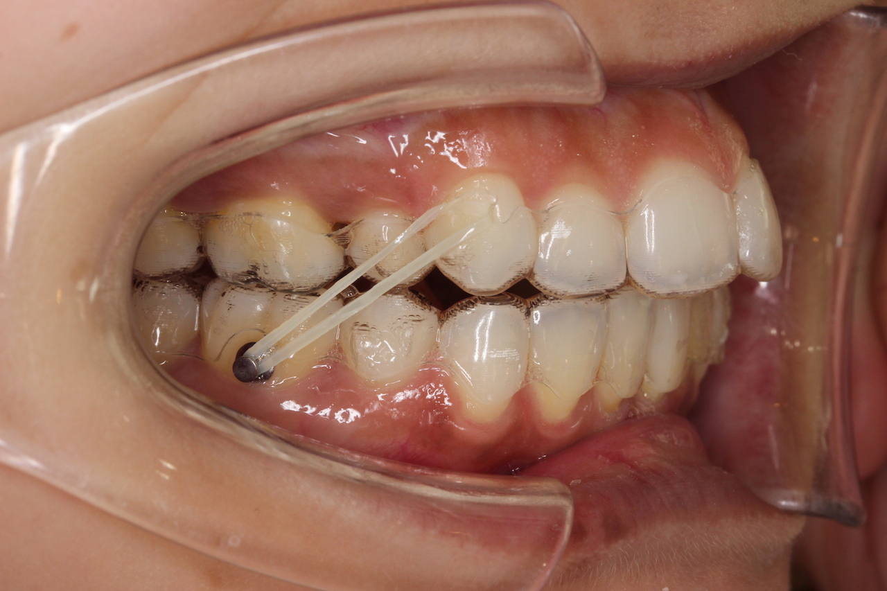 絶妙なデザイン 歯科矯正 顎間ゴム ゴムかけ 歯並び エラスティック ワイヤー インビザライン