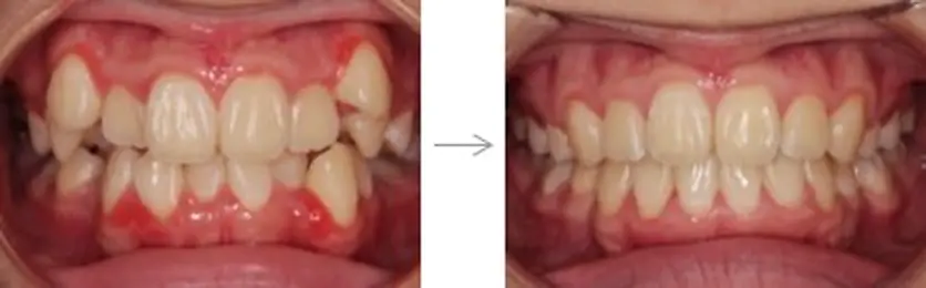 難しいケース1．抜歯症例