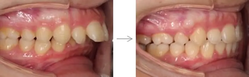 難しいケース2．上顎前突（出っ歯）