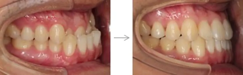 難しいケース3．下顎前突（反対咬合・受け口）