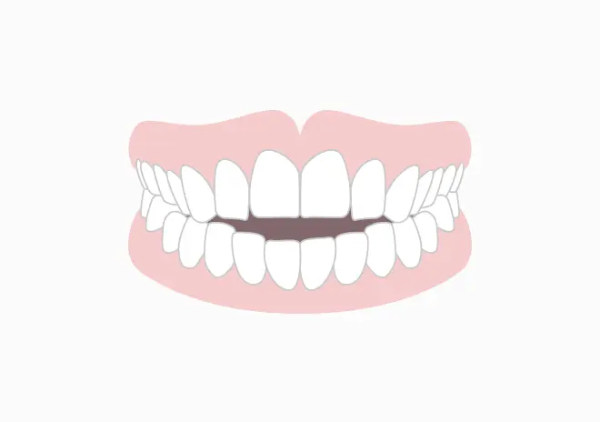 開咬（オープンバイト）