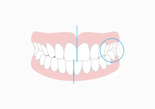 交叉咬合（クロスバイト）