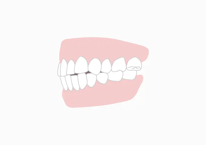 鋏状咬合（きょうじょうこうごう：シザーズバイト）