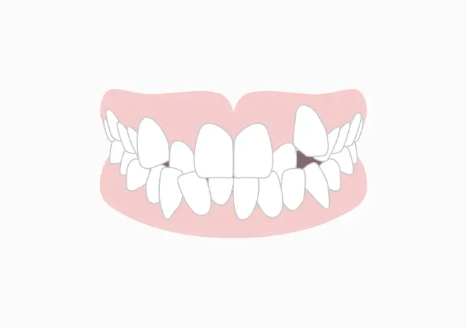 前歯がガタガタ