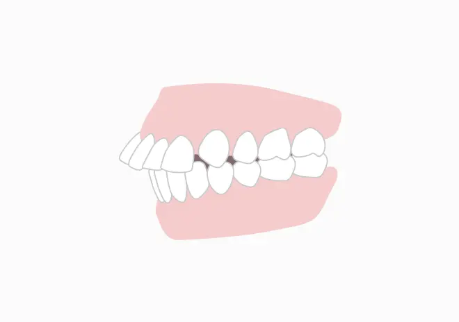 出っ歯が気になる