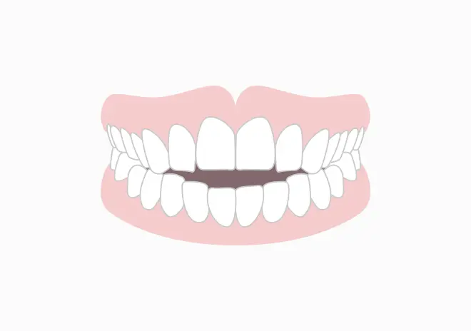 前歯がかみ合わない