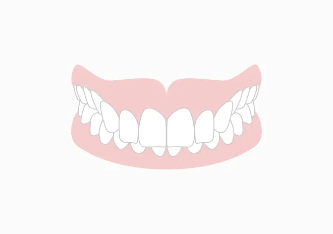 噛み合わせが深く下の歯が隠れる