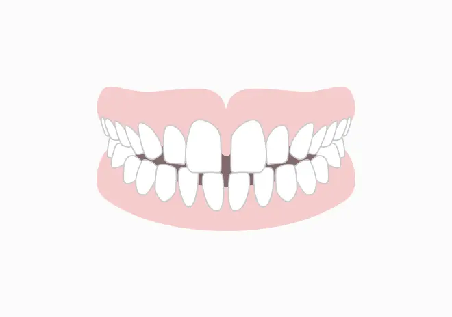 すき間が気になる