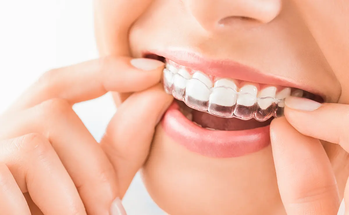 マウスピース型矯正装置(インビザライン)