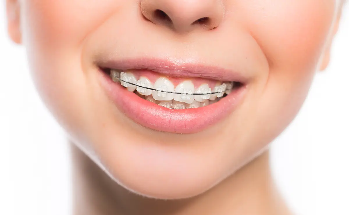 ワイヤーによる表側矯正