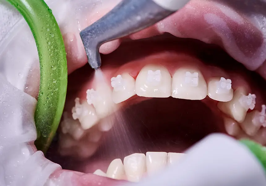 治療終了・矯正装置の撤去