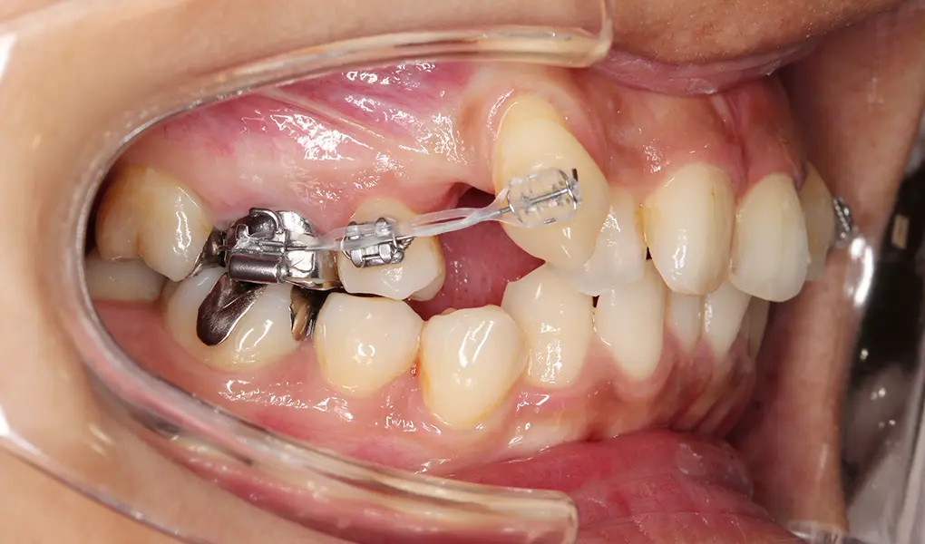 セクショナルアーチ