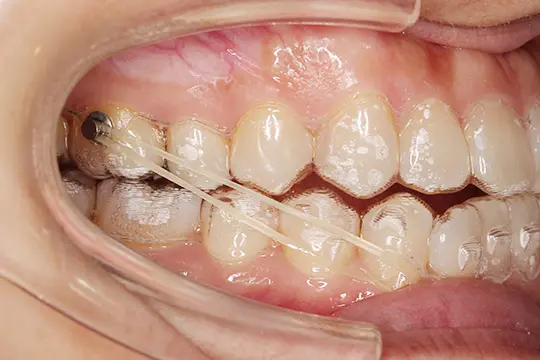 顎間ゴム（エラスティック）