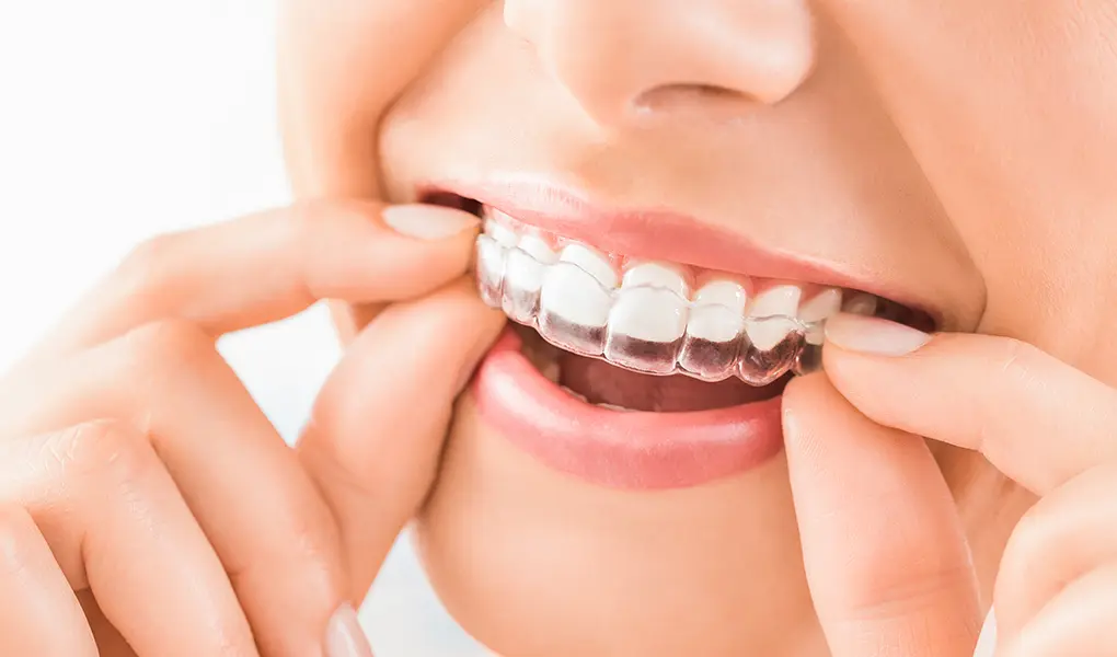 マウスピース型矯正装置（インビザライン）