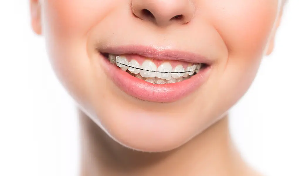 ワイヤーによる表側矯正