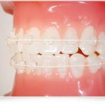 矯正治療日記 vol.10　部分矯正 ④