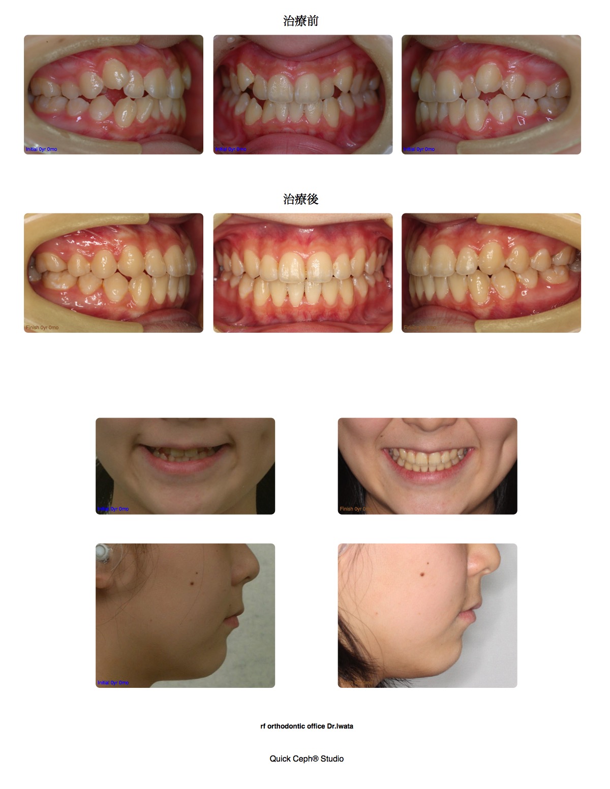 叢生症例 　＜マウスピース装置による非抜歯矯正治療＞