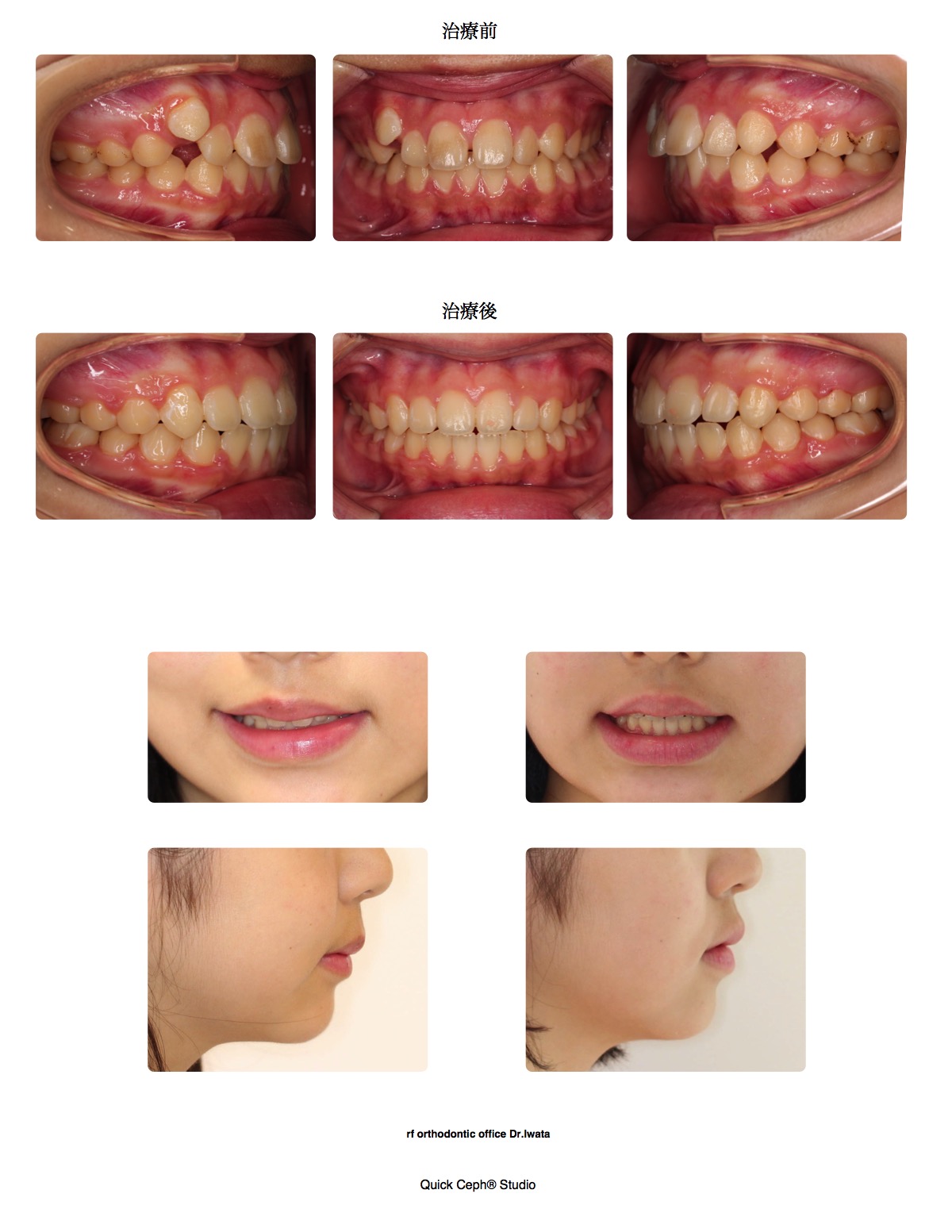 空隙歯列症例 <非抜歯矯正治療>