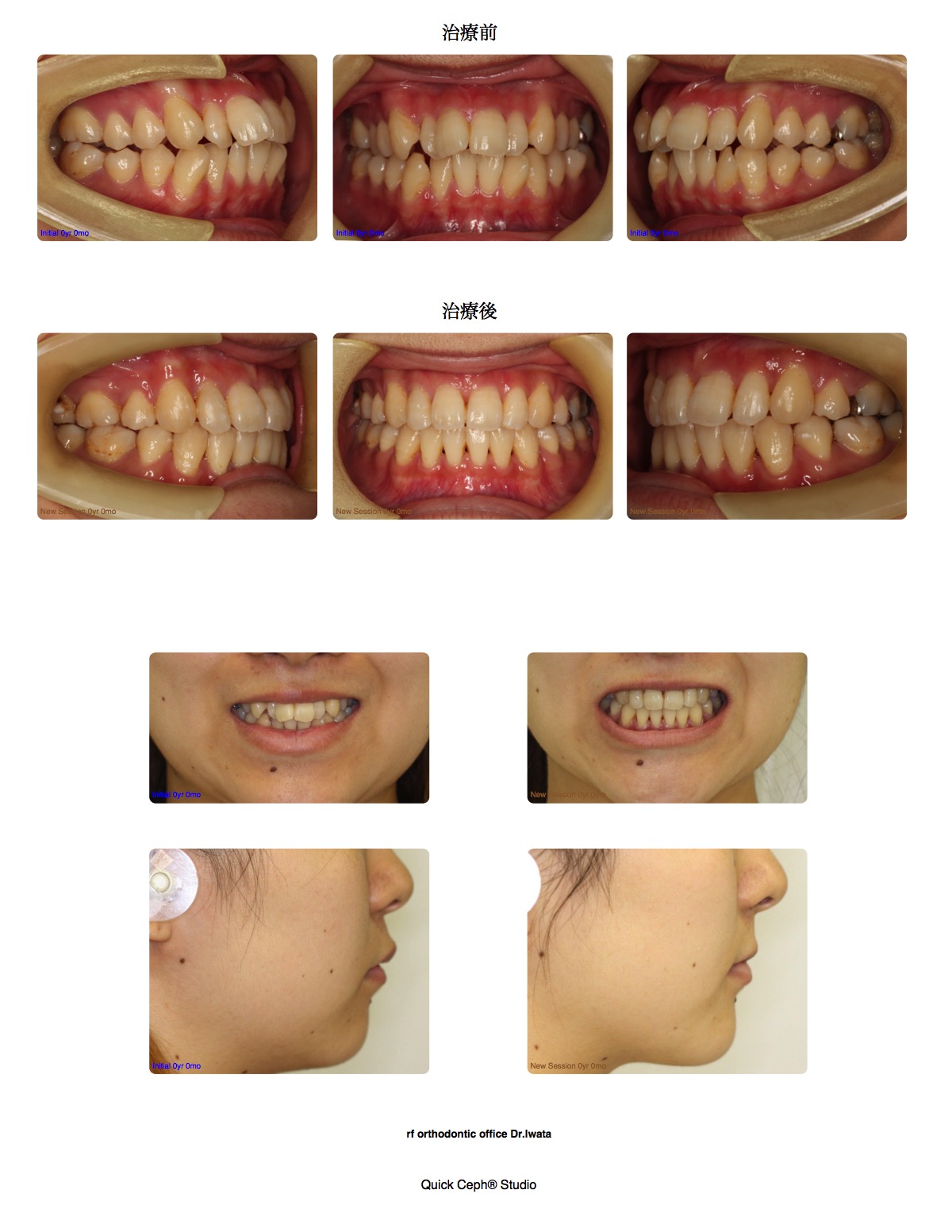 上下顎前突症例 <上下顎第一小臼歯抜歯矯正治療>