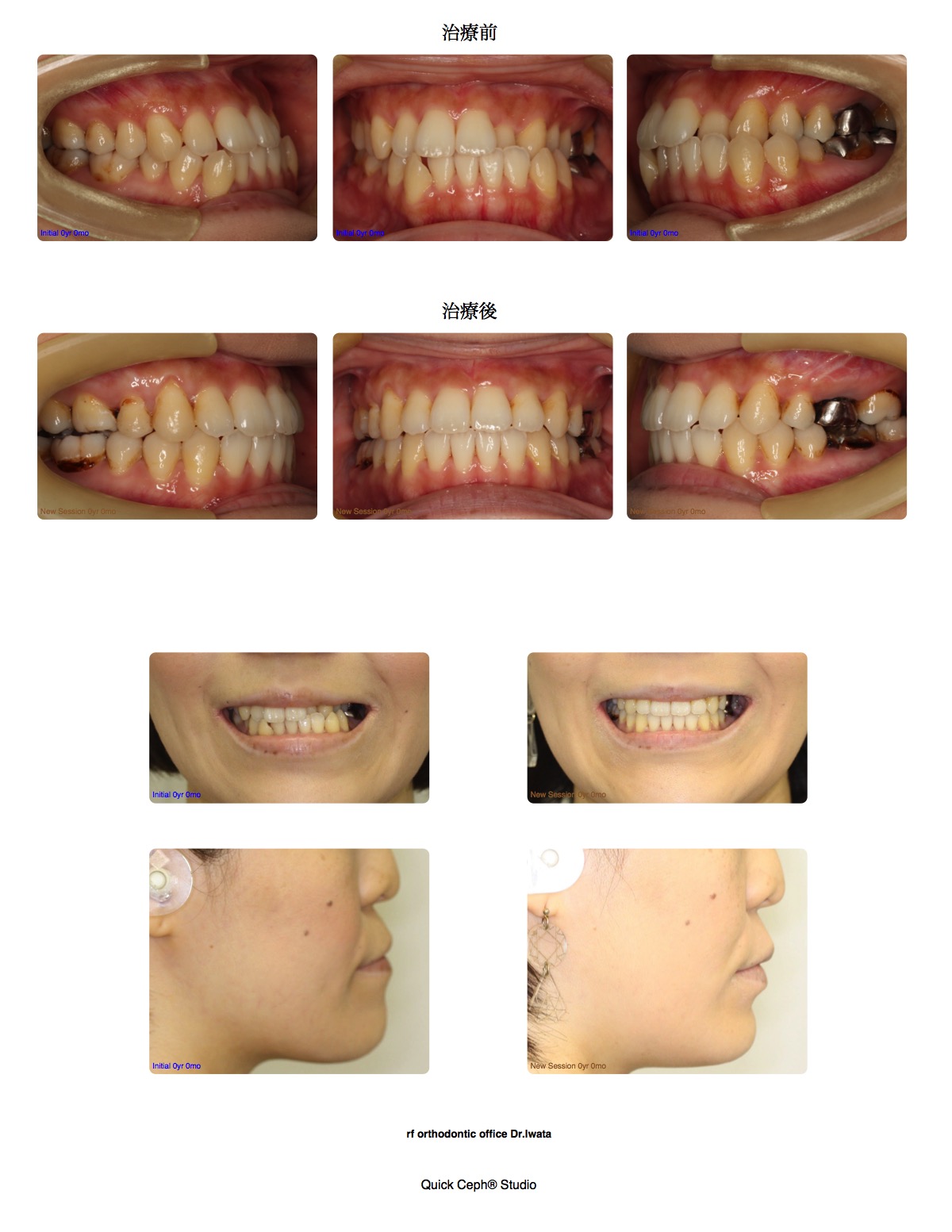 交叉咬合症例　＜顎矯正手術を併用した上顎第一小臼歯抜歯矯正治療＞
