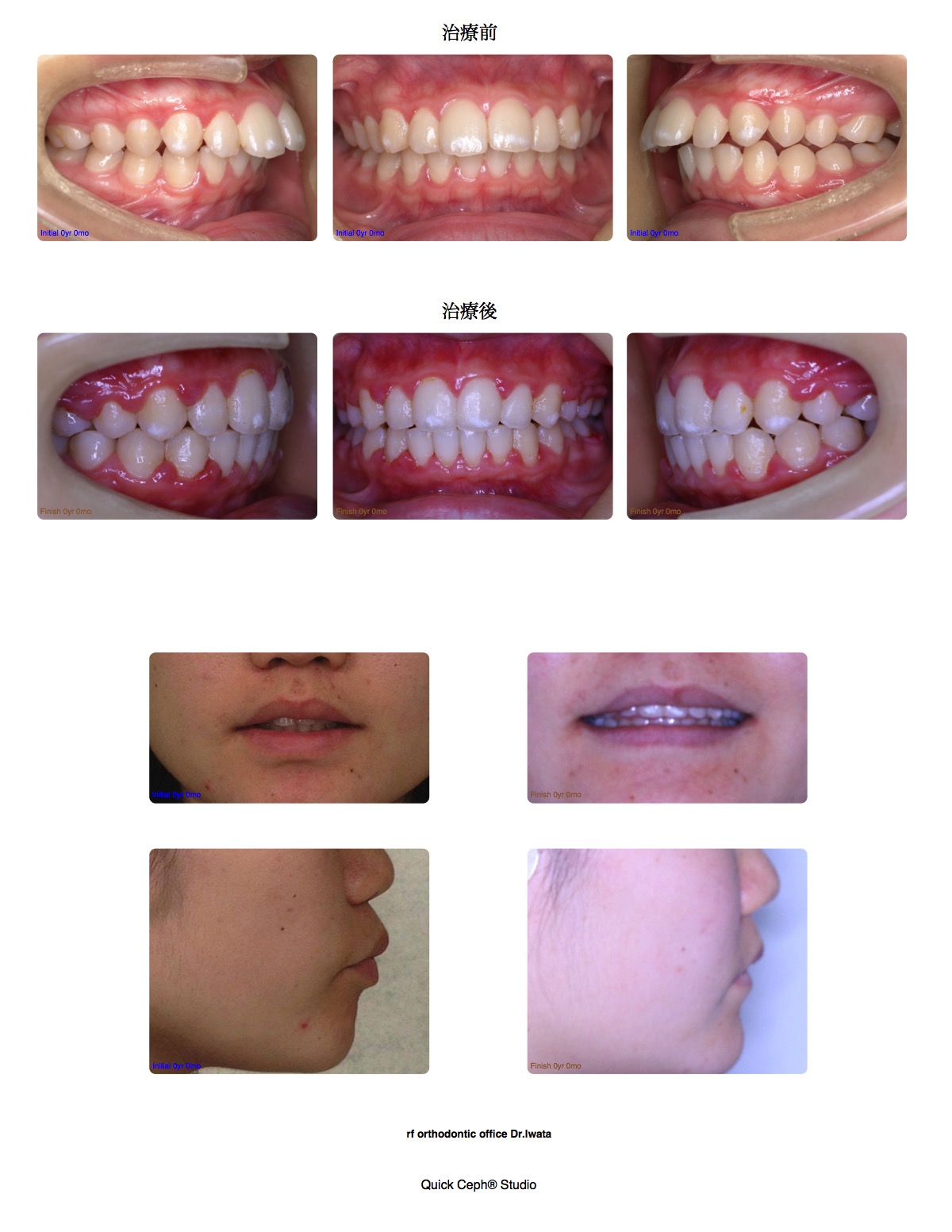上顎前突症例 <上顎第一小臼歯抜歯矯正治療>