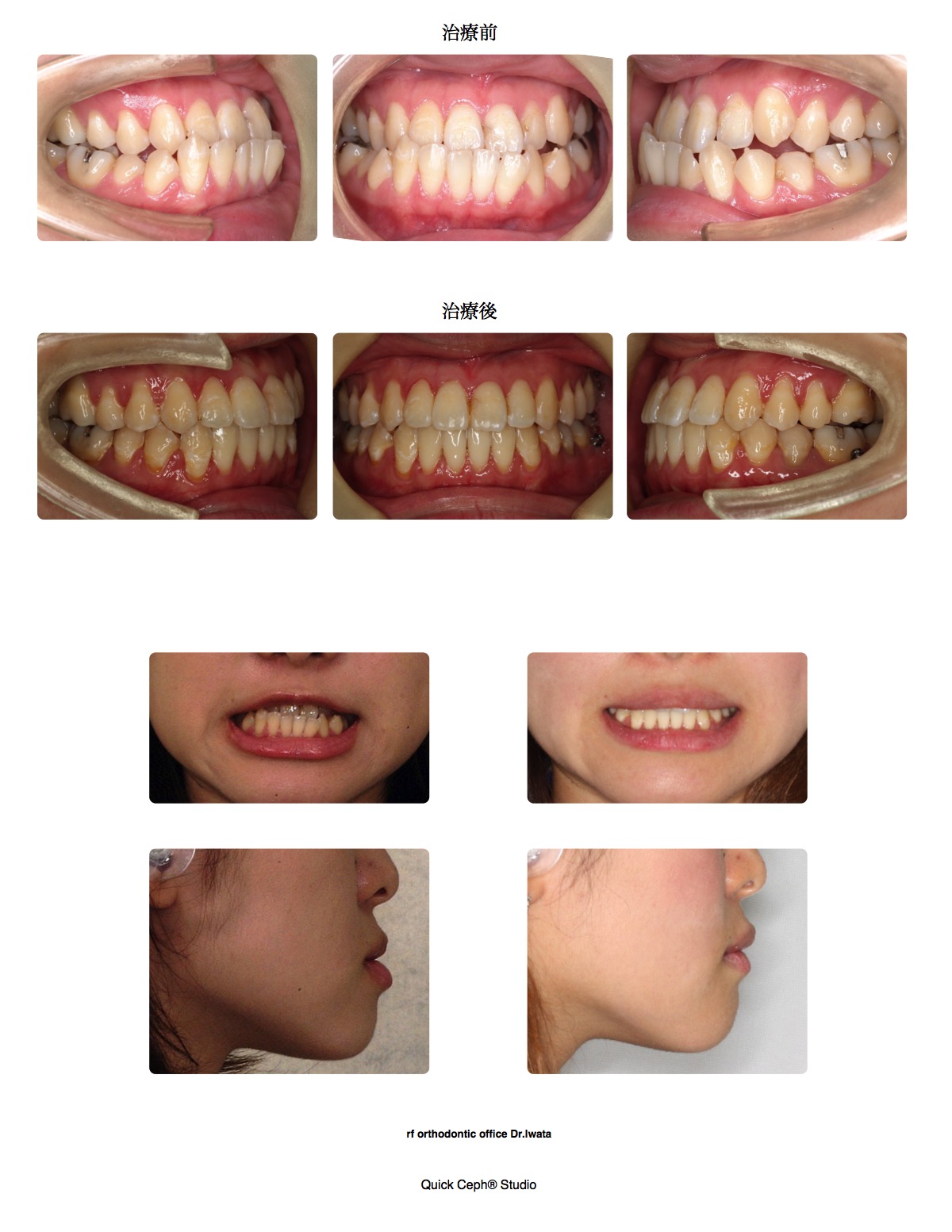 下顎前突症例 <矯正用インプラントを併用した非抜歯矯正治療>