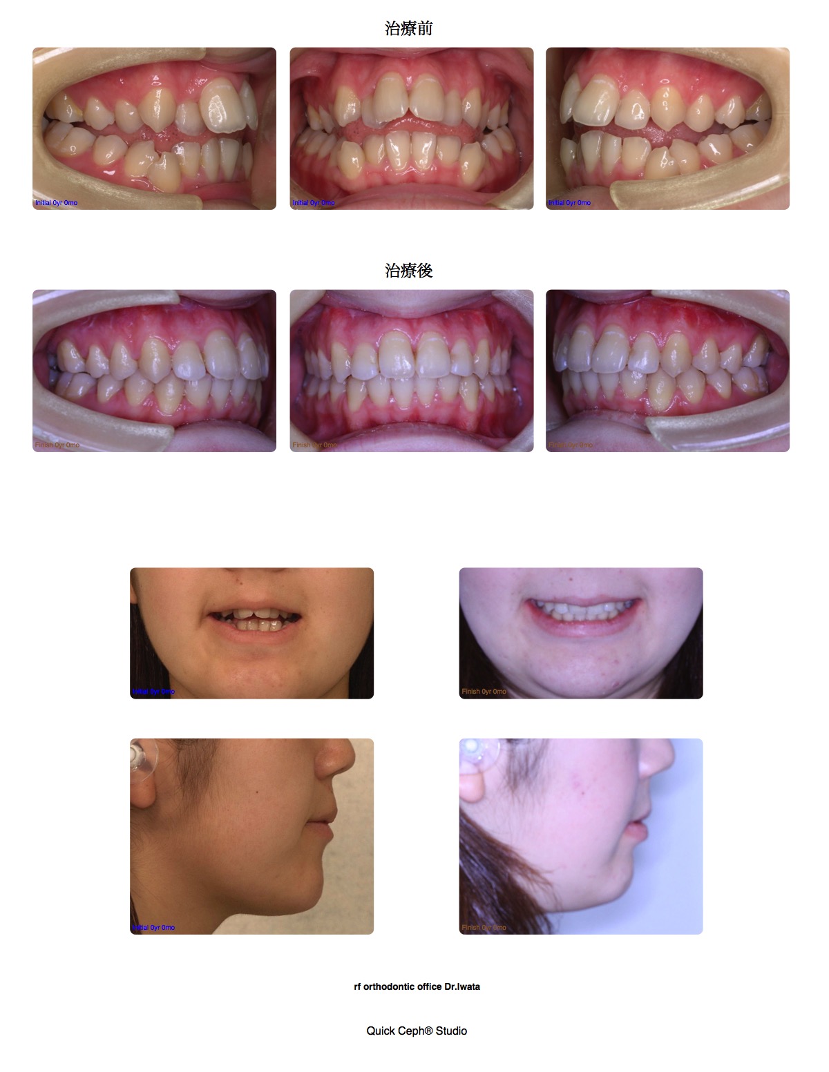 開咬症例 <拡大装置と顎間ゴムを併用した非抜歯矯正治療>