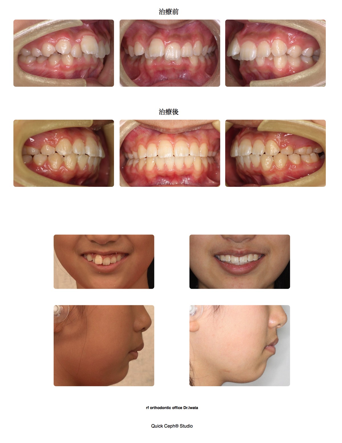 過盖咬合症例　＜上顎第一小臼歯抜歯矯正治療＞