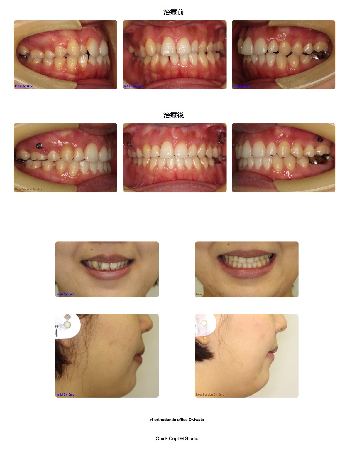 交叉咬合症例　＜矯正用インプラントを併用した上顎右側第一小臼歯抜歯矯正治療＞