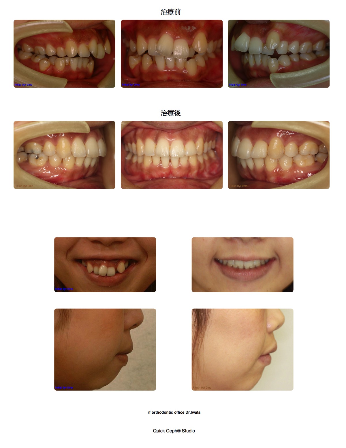 叢生症例 <ワイヤー装置とマウスピース装置を併用した上下顎第一小臼歯抜歯矯正治療>