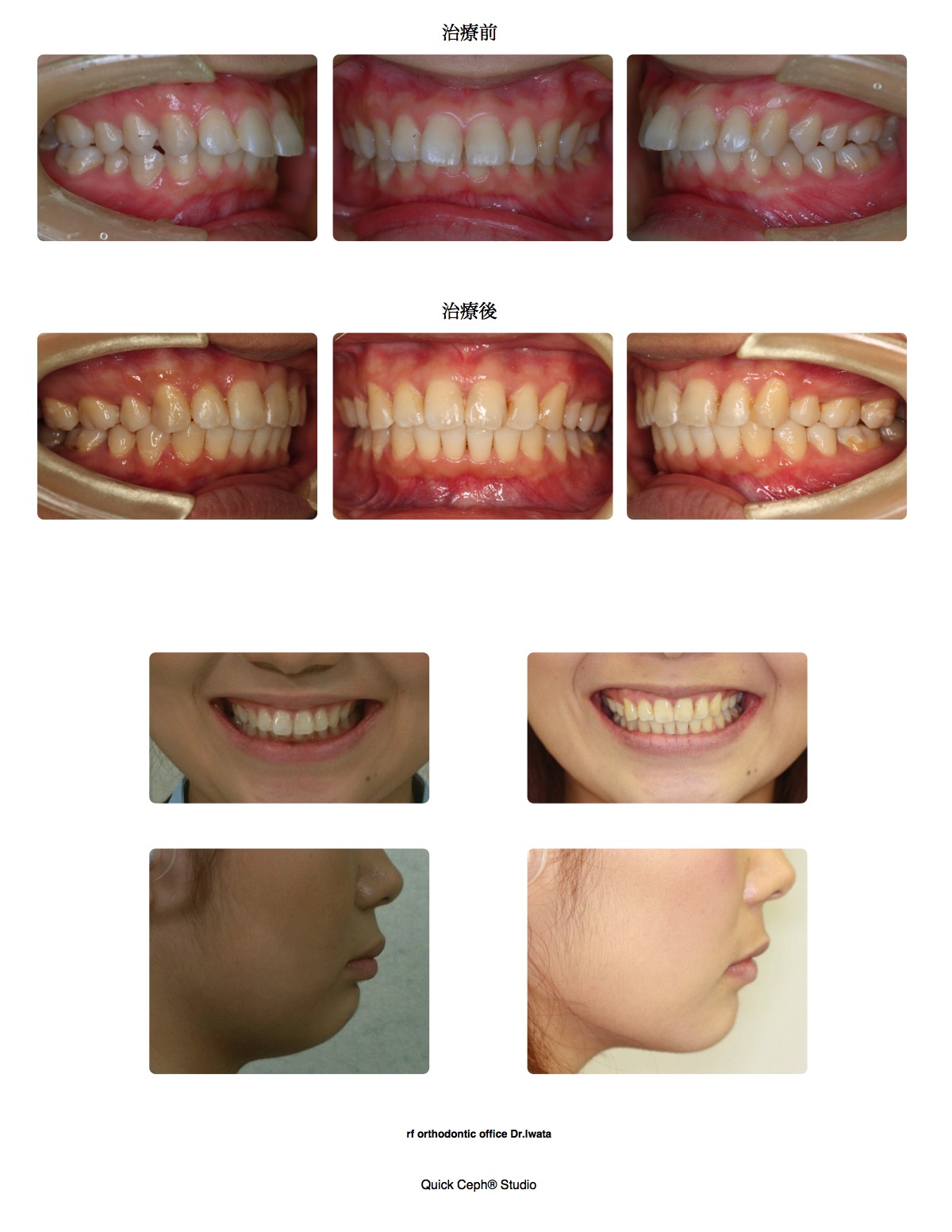 上顎前突症例 <上顎第一小臼歯抜歯矯正治療>