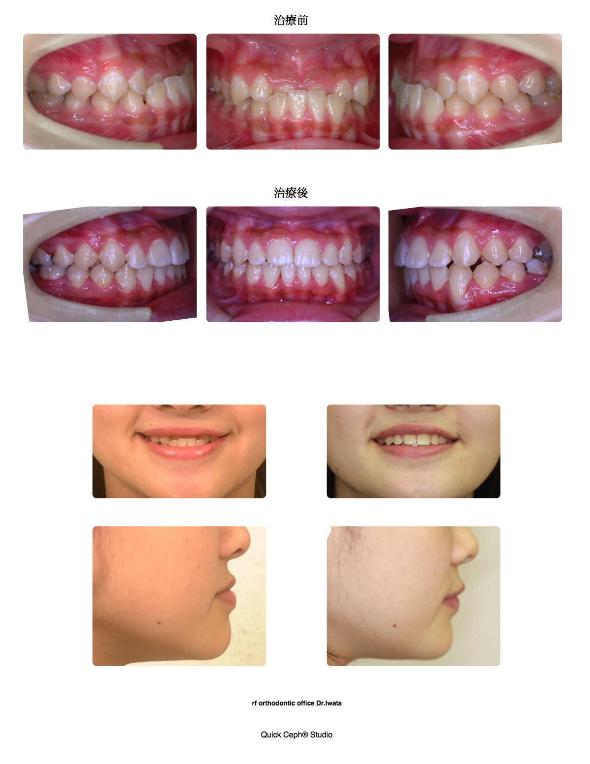 下顎前突症例　＜顎間ゴムを併用したマウスピース装置による非抜歯矯正治療＞
