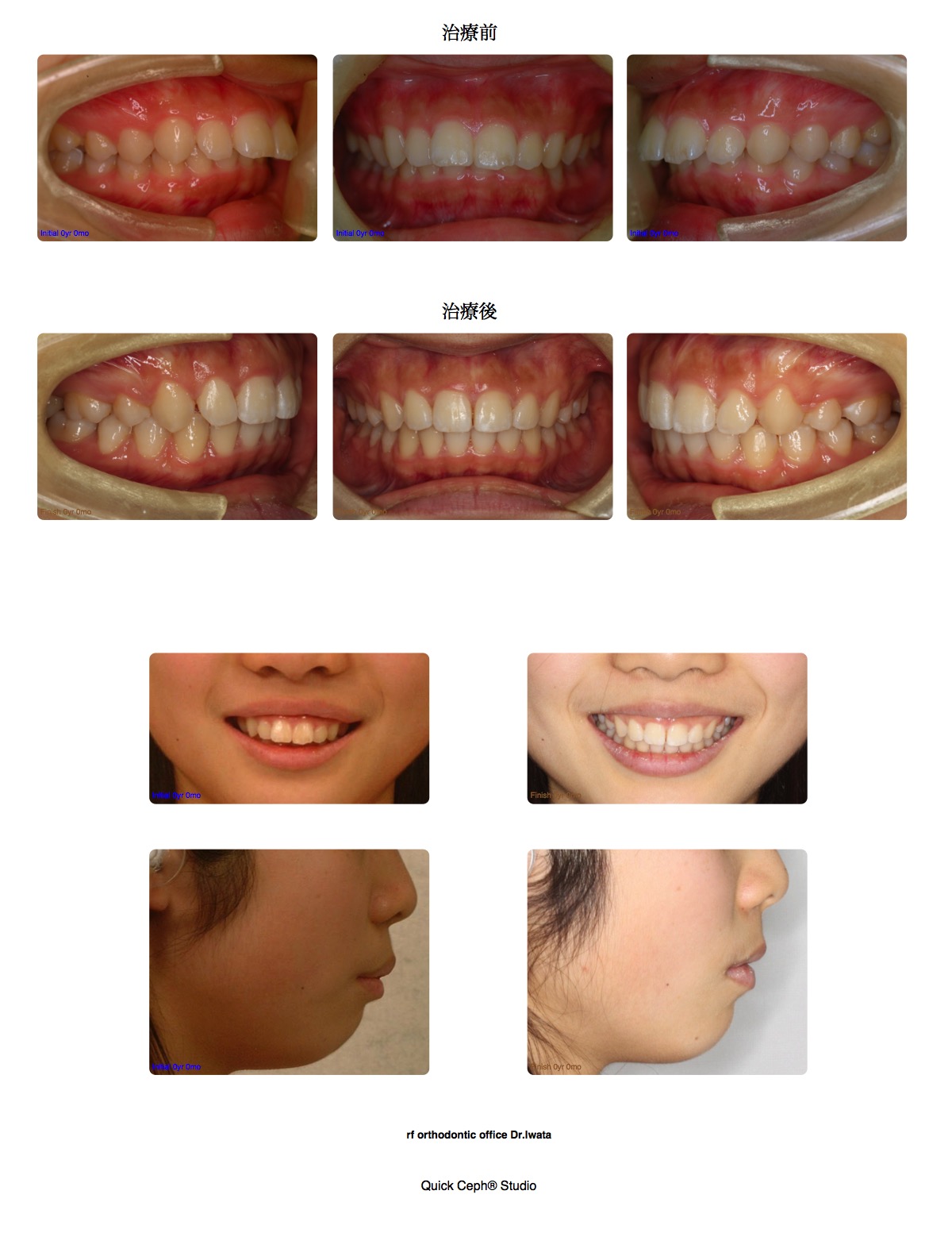 過盖咬合症例　＜上顎第一小臼歯抜歯矯正治療＞