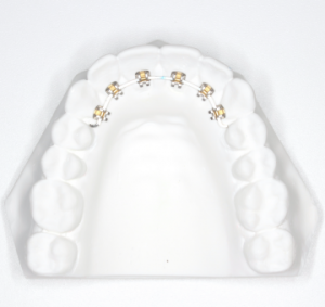 矯正治療日記 vol.10　部分矯正 ④
