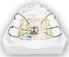 矯正治療日記 vol.10　部分矯正 ④