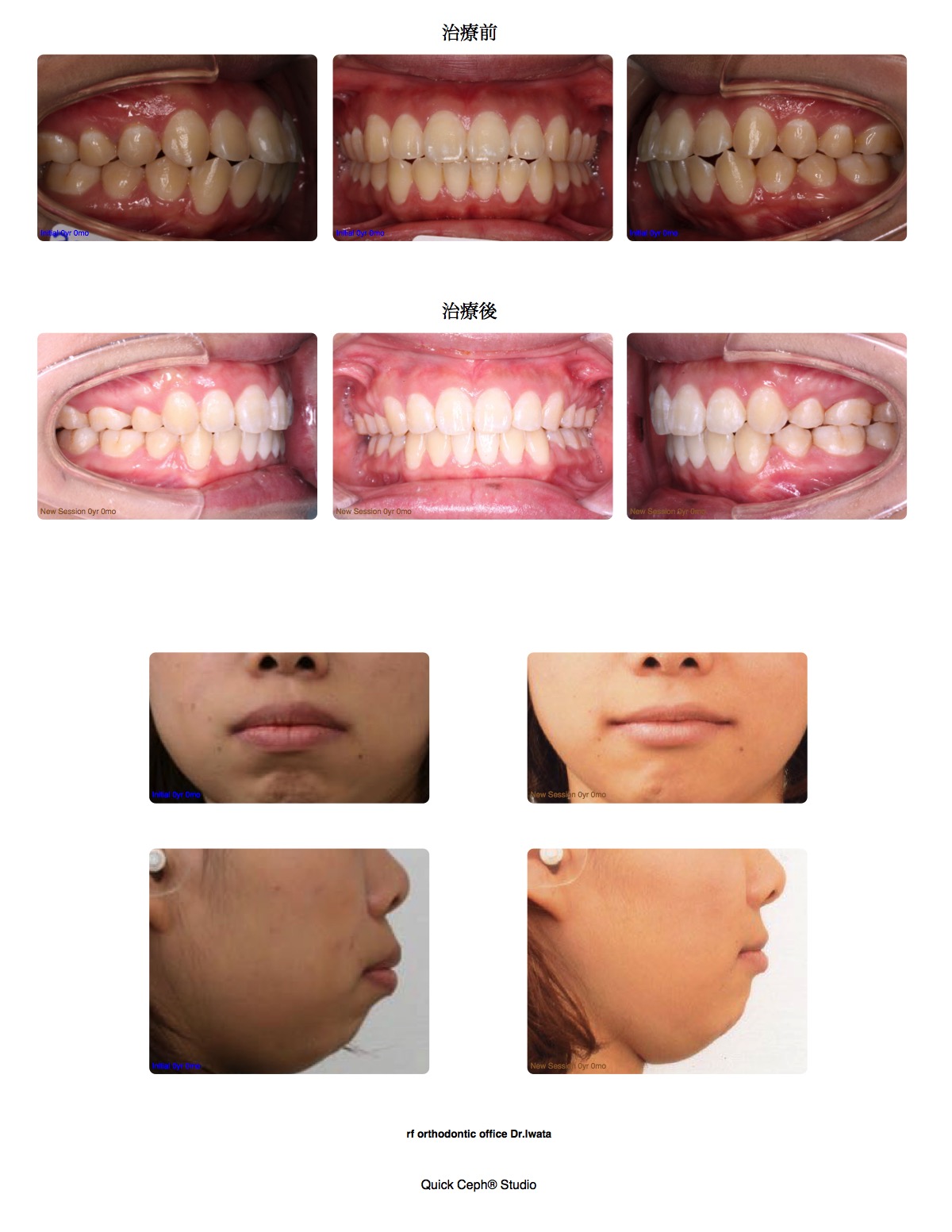 上下顎前突症例 <矯正用インプラントを併用した上下顎第一小臼歯抜歯矯正治療>