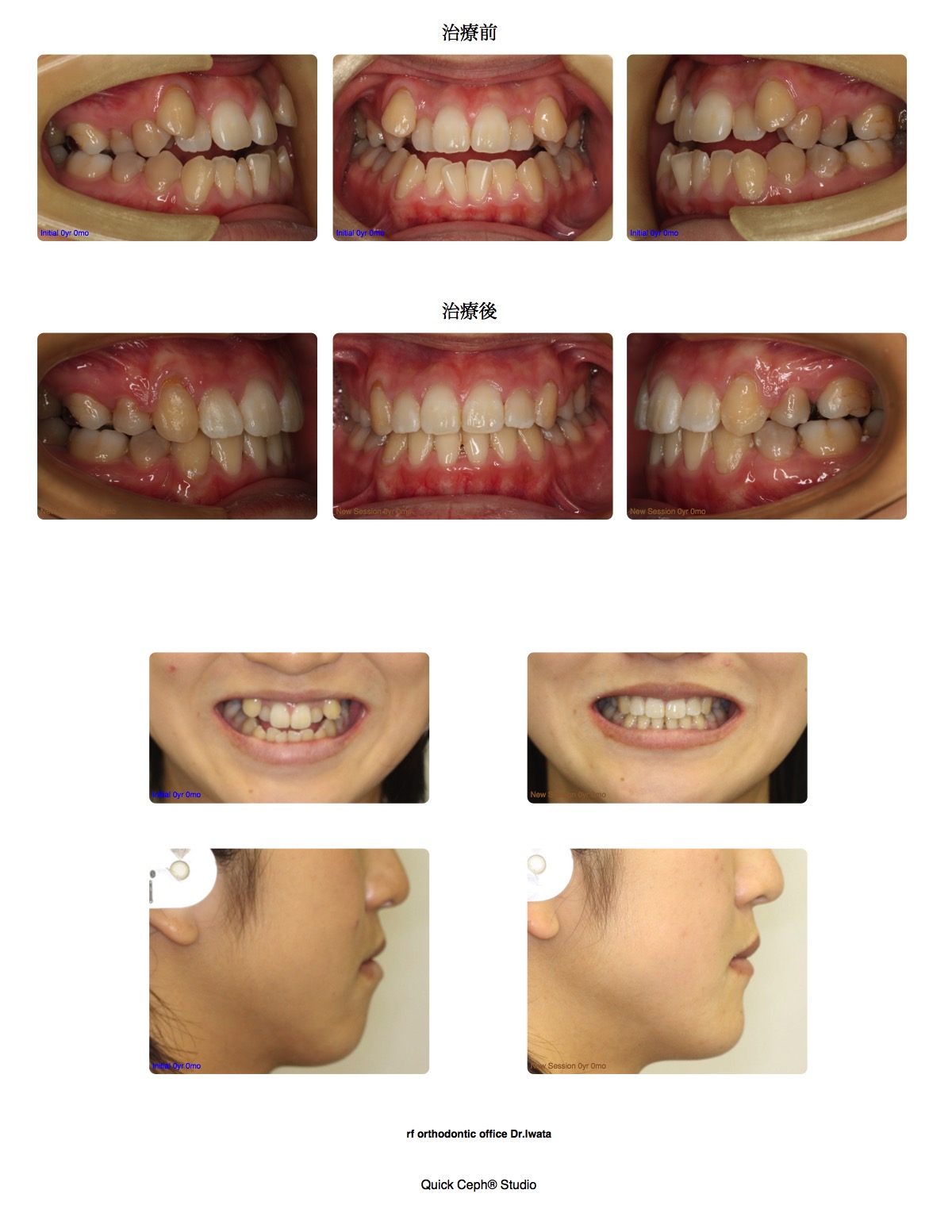 開咬症例　＜顎間ゴムを併用した上下顎第一小臼歯抜歯矯正治療＞