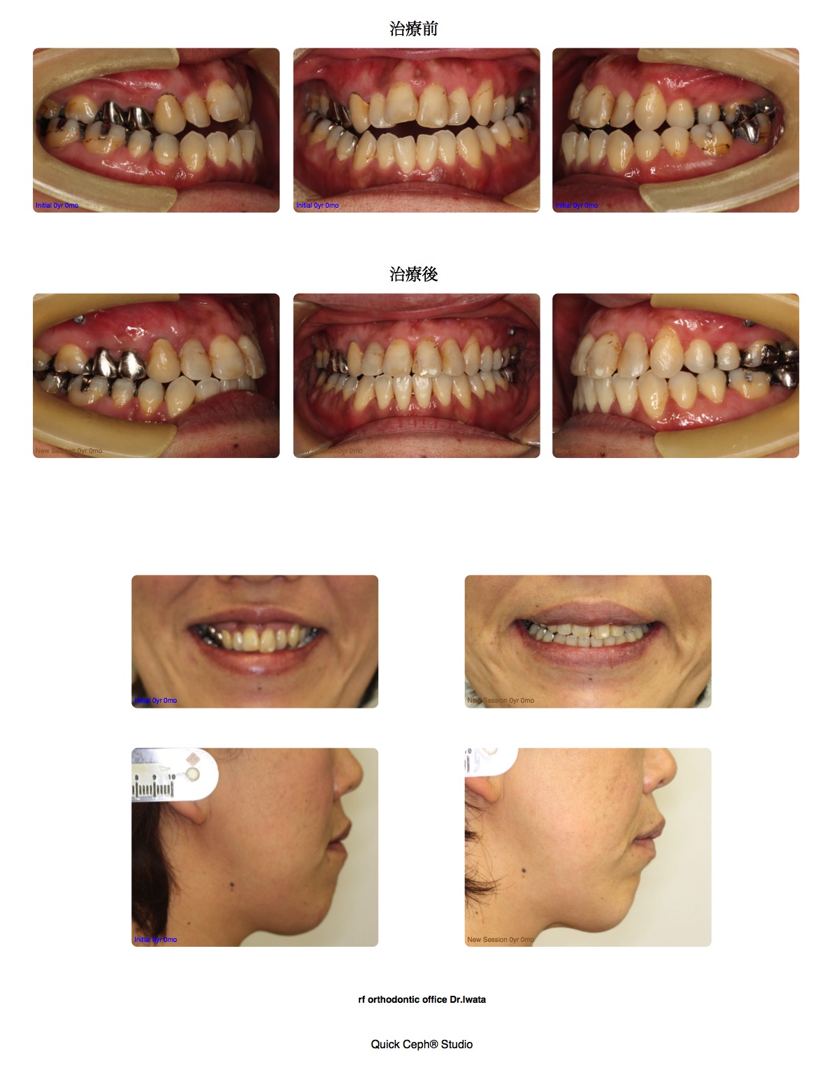 交叉咬合症例　＜矯正用インプラントを併用した非抜歯矯正治療＞