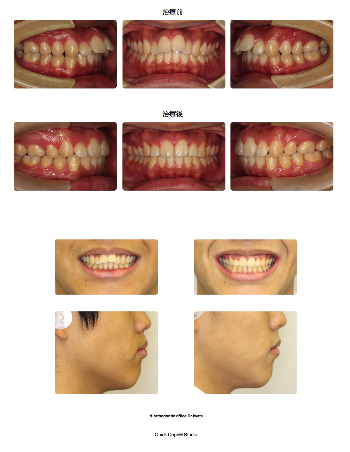上顎前突症例 　＜上顎第一小臼歯抜歯矯正治療＞