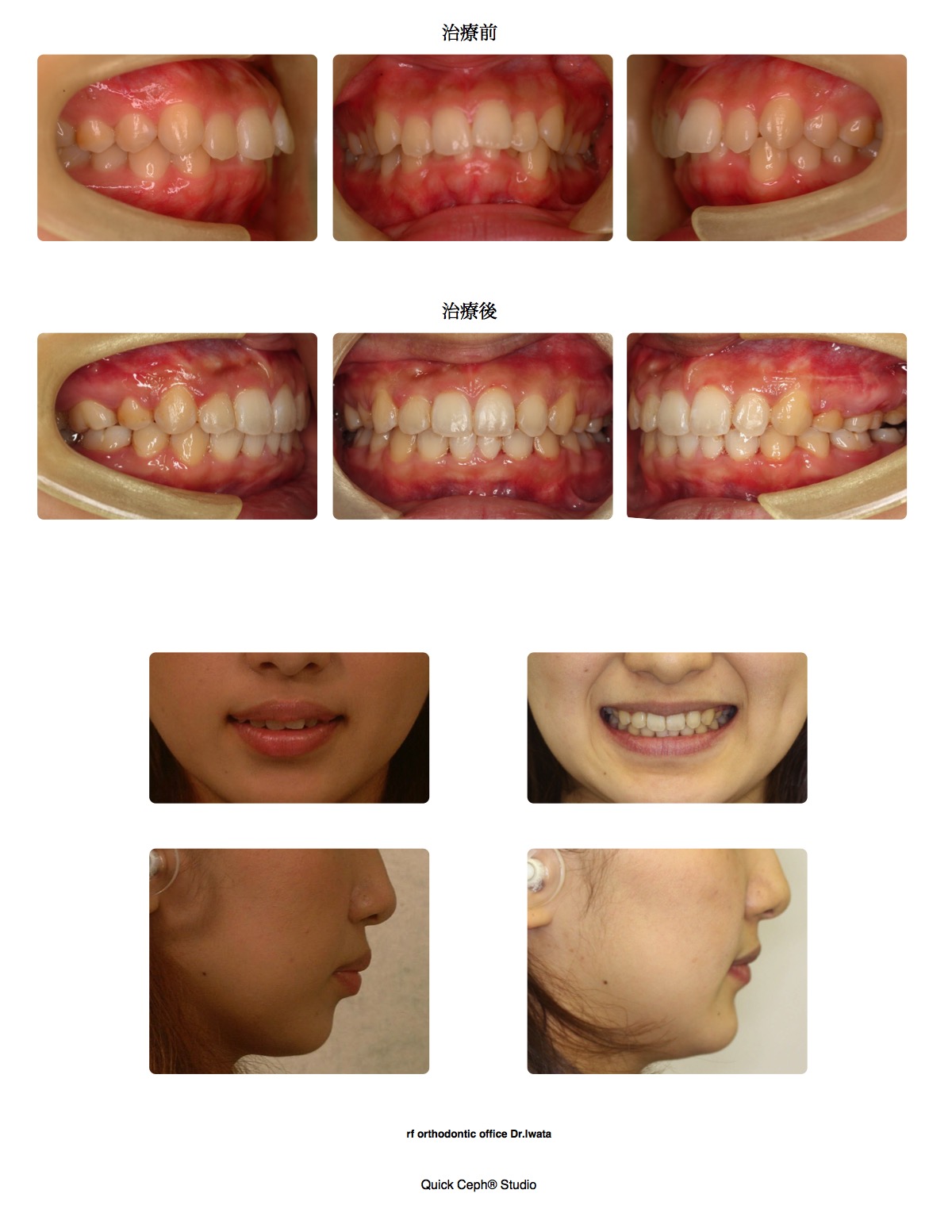 過盖咬合症例　＜上下顎第一小臼歯抜歯矯正治療＞