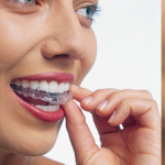 矯正治療日記 vol.13　「マウスピース型矯正装置（インビザライン）の見た目」