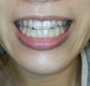 矯正治療日記 vol.13　「インビザラインの見た目」