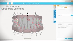 マウスピース矯正は、通常の矯正に比べ、きれいに治らないと聞きましたが？