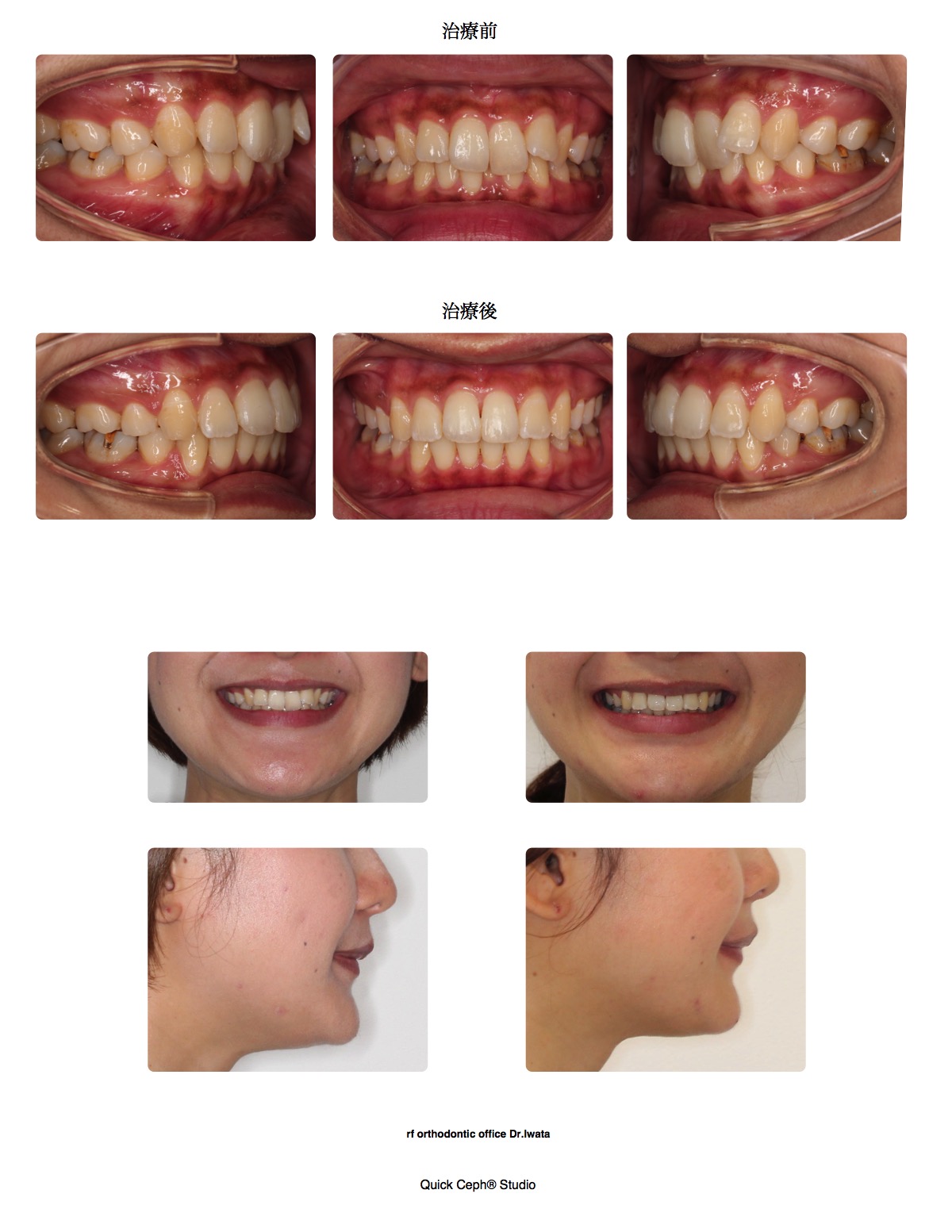 叢生症例　＜矯正治療の後戻りに対する非抜歯矯正治療＞