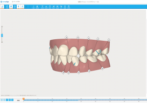 マウスピース矯正の治療期間は通常の矯正に比べ、どのくらい違うのでしょうか？