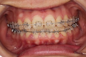 出っ歯バイバイ…