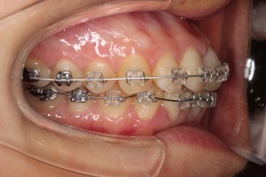 出っ歯バイバイ…