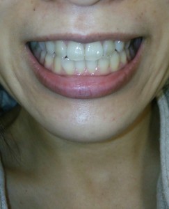 インビザライン☆