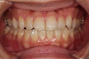 インビザライン②