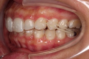 アライナーを新調?